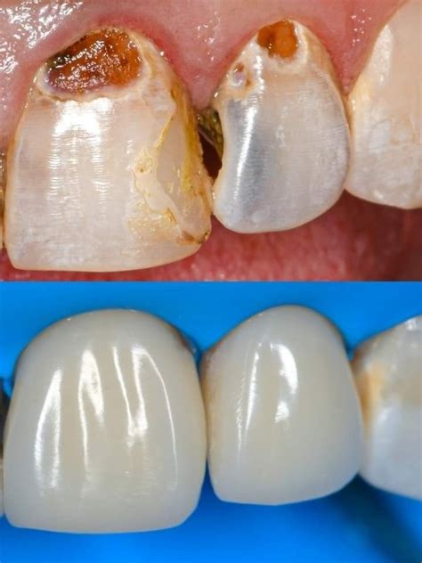 Dentes Livres De T Rtaro Em Minutos O M Todo Que Funciona Denti