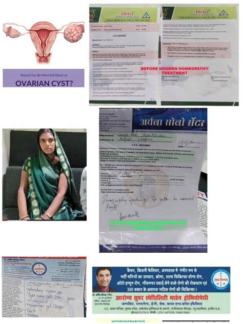 Large Ovarian Cyst Cured Without Surgical Procedur