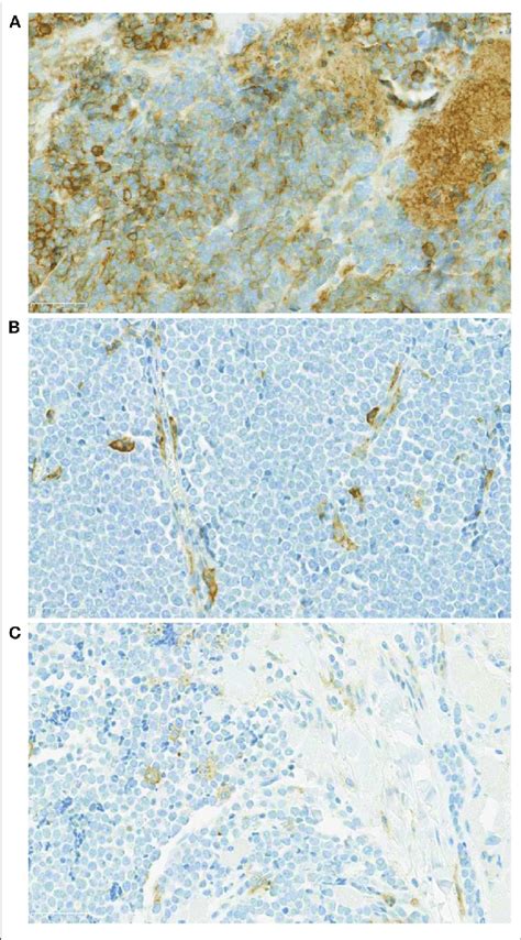 A Pd L Staining Of A Merkel Cell Carcinoma Case X