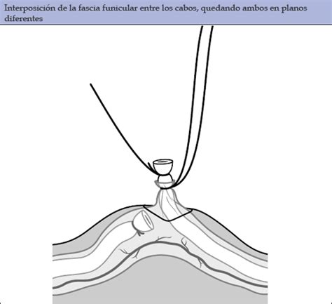 Procedimiento Vasectomía