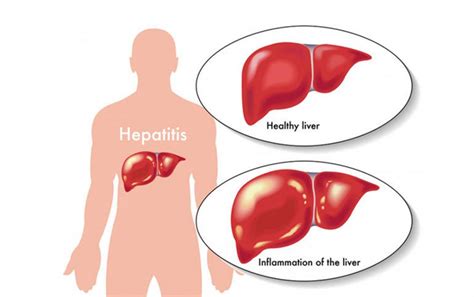 Fun Facts About Hepatitis This Quarterly