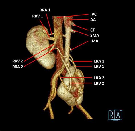 3D CT Angiography Image Of A 58 Year Old Female Patient With Left