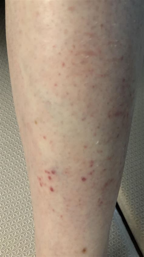 Redness on shins : r/medical_advice