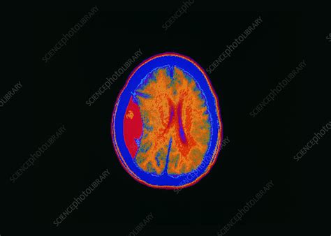 Coloured Ct Scan Showing A Brain Haemorrhage Stock Image M1360052