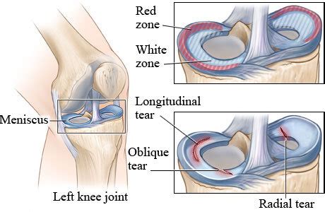 MENISCUS KNEE TEAR: CAUSES, SYMPTOMS, AND TREATMENT - Care2Cure ...