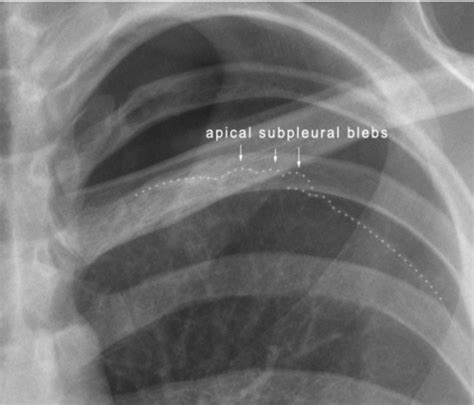 Fm Eor Pulmonology Flashcards Quizlet