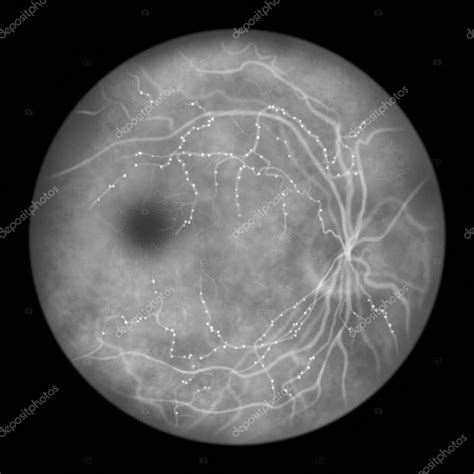 Retinopatía Diabética Forma Clínica R1 Antecedentes Con