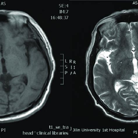 Patient S Axial T1 And T2 Weighted Images Showing Lacunar Infarction In Download Scientific