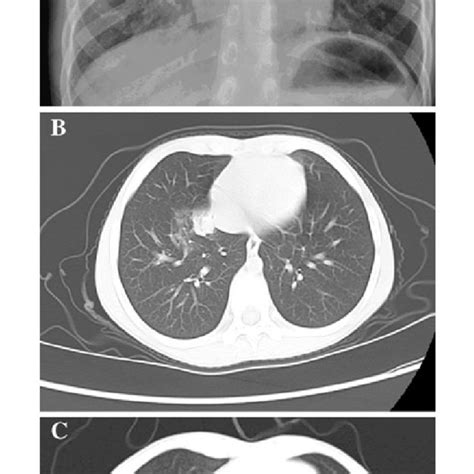 A Chest Radiographs Of The Index Case Showing Patchy Opacities And Edge