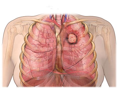 Bronchial Carcinoid Tumor