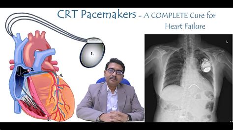 CRT P CRT D Pacemaker Complete Cure For Heart Failure YouTube