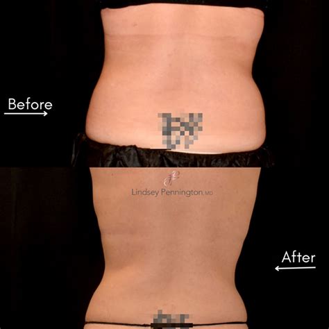 Coolsculpting Before And After Pennington