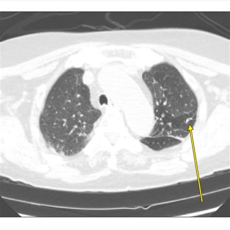 Focal Pulmonary Thromboembolism At Small Branch Of The Left Lower Lung Download Scientific