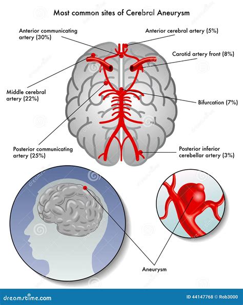 Cerebral Aneurysm Stock Vector Illustration Of Double 44147768