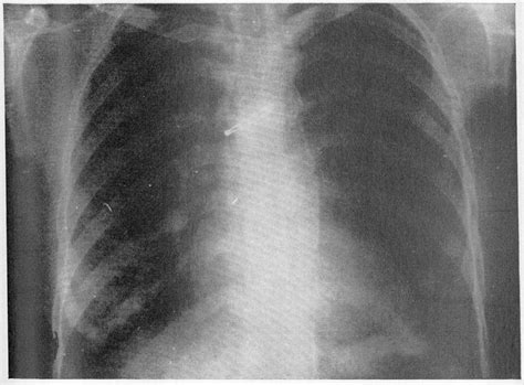 Figure 1 from Extensive Aortic Calcification in a Case of Primary ...