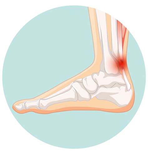 Rotura Tendón de Aquiles Síntomas Causas y Tratamiento Blog de