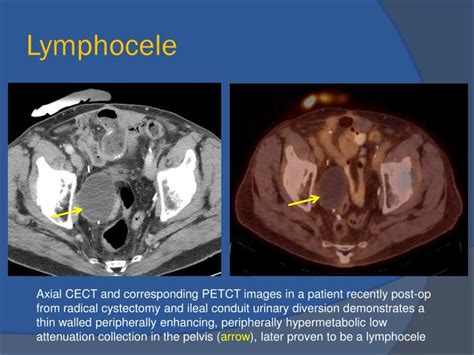 PPT - Multi-modality Imaging of Urinary Diversion Complications PowerPoint Presentation - ID:2241761