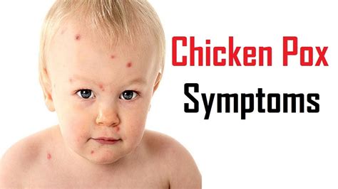 6 Early Signs And Symptoms Of Chicken Pox Youtube