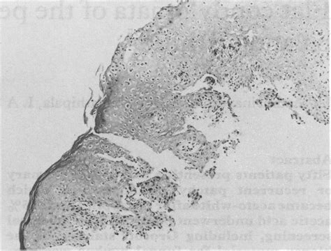 Photomicrograph showing typical koilocytes in stratified squamous ...