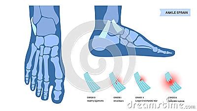 Sprained Ankle Injury Vector Illustration Cartoondealer