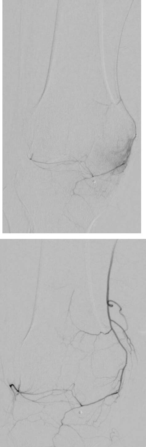 Genicular Artery Embolization Technique Techniques In Vascular