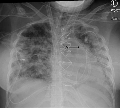 Right Heart Failure Management Focus On Mechanical Support Options