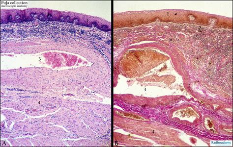 Esophageal Varices Histology