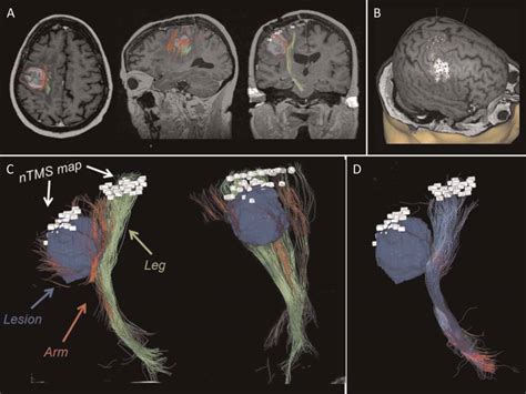 Navigated Transcranial Magnetic Stimulation for “Somatotopic” Tractography of the Corticospinal ...