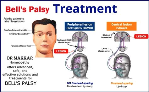bells palsy homeopathic treatment idiopathic facial paralysis