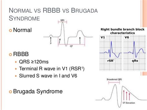 Brugada