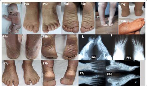 Patients 5 7 With Autosomal Recessive Congenital Ichthyosis Collodion