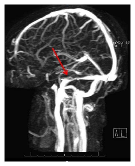 Mrv Showing Narrowing Of The Transverse Venous Sinuses Most Likely