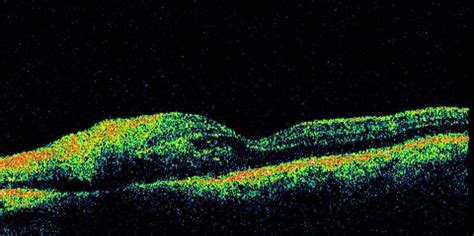 A Focal Mycotic Chorioretinitis B Oct Of The Chorioretinal Lesion