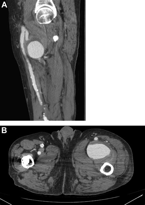 A Preoperative Sagittal Computed Tomography Angiography Demonstrating