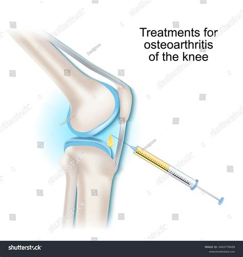 Treatments Osteoarthritis Knee Joint Syringe Intra Articular Stock