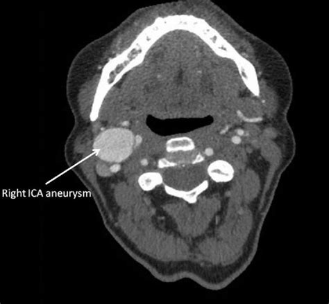 Angio Ct Scan Lateral View Of The Right Carotid Axis Download