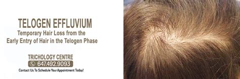 What is Telogen Effluvium? – Hair Loss Clinic | PRP, Laser Light ...