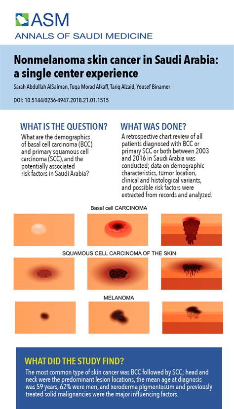 Nonmelanoma Skin Cancer In Saudi Arabia Single Center Experience