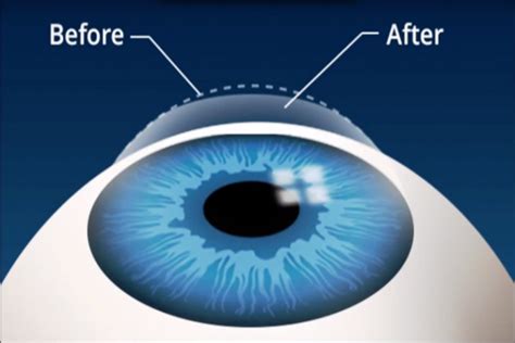 The Differences Between Lasik And Lasek Eye Surgery Global Beauty LLC