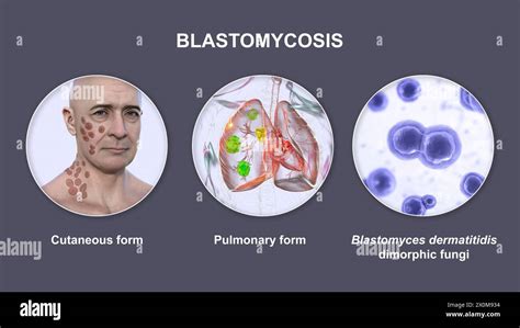 3d Illustration Showing Two Clinical Presentations Of Blastomycosis And A Close Up View Of