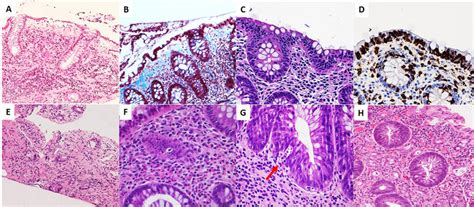 Non IBD Colitis Non Infective Colitis A Collagenous Colitis The