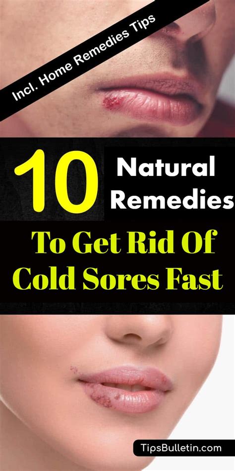 Top 10 Natural Remedies To Get Rid Of Cold Sores Fast Cold Sore Get Rid Of Cold Healthy Beauty