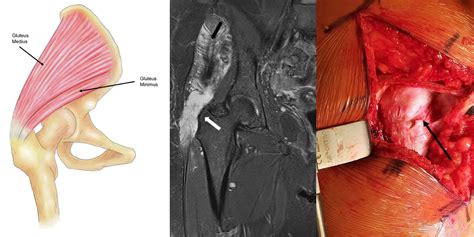 Hip Abductor Tendon Tears—a Survey Of New Zealand Orthopaedic Surgeons The New Zealand Medical