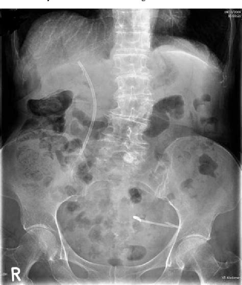 inguinal abscess | Semantic Scholar