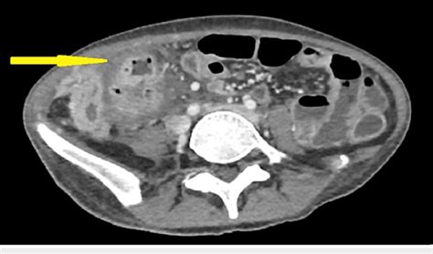 CT scan (Axial cut) showing a heterogenous enhancing collection (yellow ...