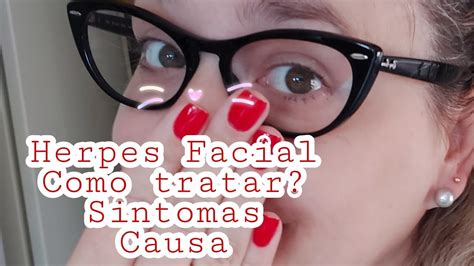 Herpes Facial Aconteceu de novo Como tratar sinais do vírus e pomada