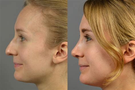 Nose Surgery Before After Patient 14 Dr Marotta