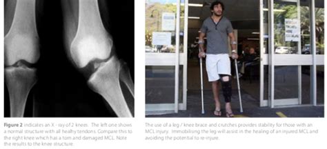 Medial Collateral Ligament Mcl Injury Sports Clinic Nq