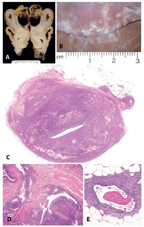 Endometriosis And Adenomyosis A And B Variation In The Gross