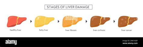 Etapas del daño hepático no alcohólico Saludable graso esteatosis